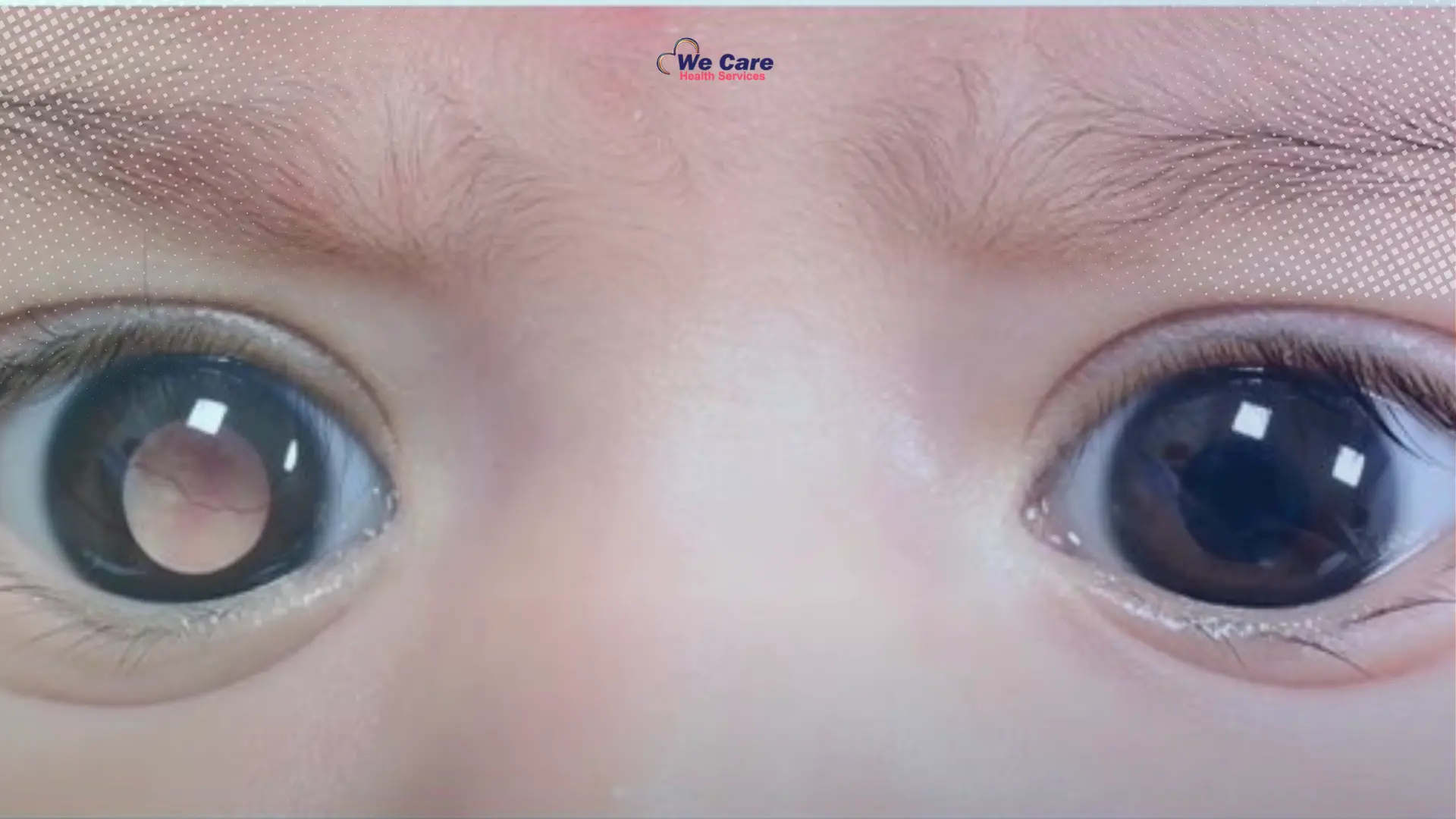 Retinoblastoma Treatment in India