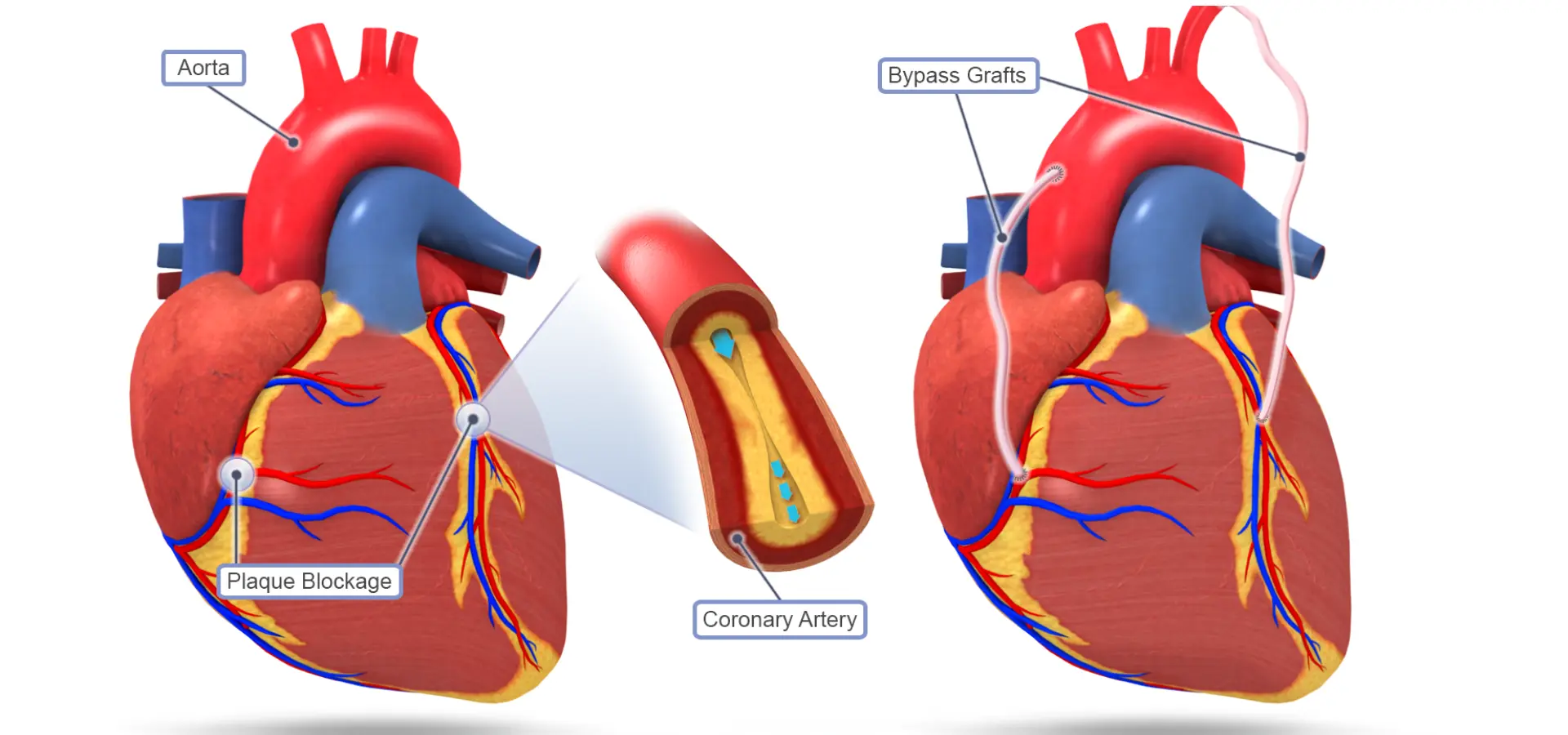 Vascular Aortic Aneurysm Repair Surgery in India