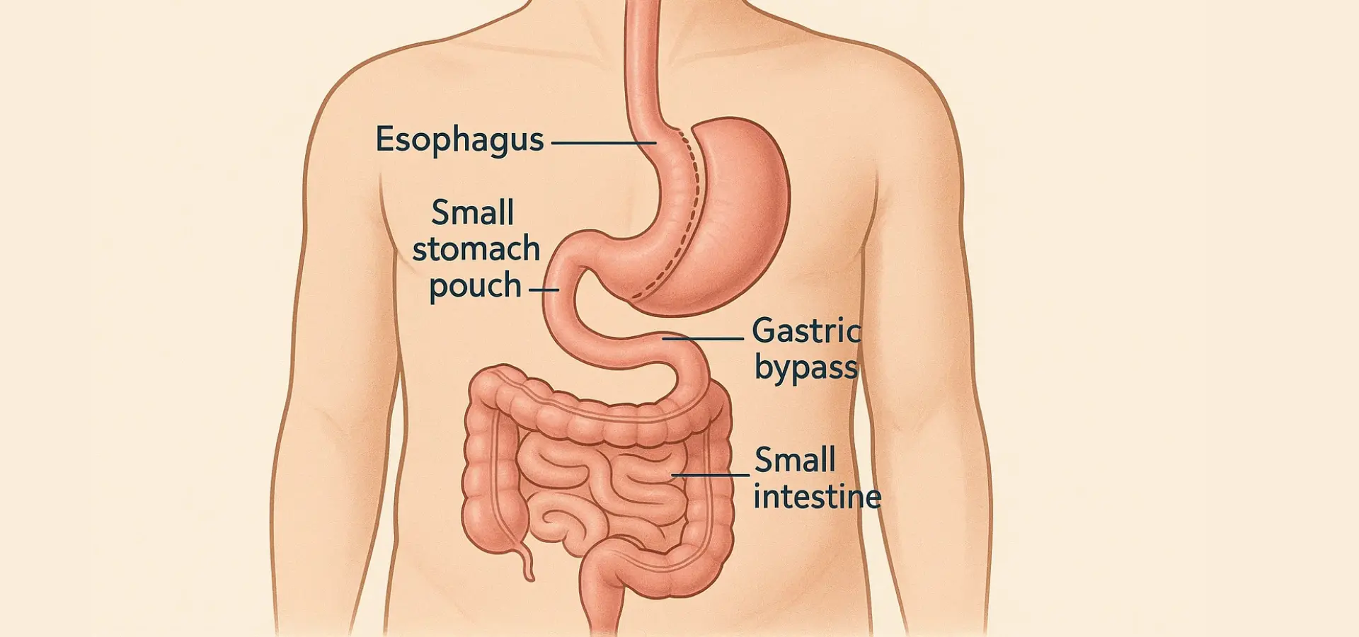 Bariatric Surgery Overview