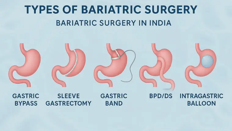 Types of Bariatric Surgery