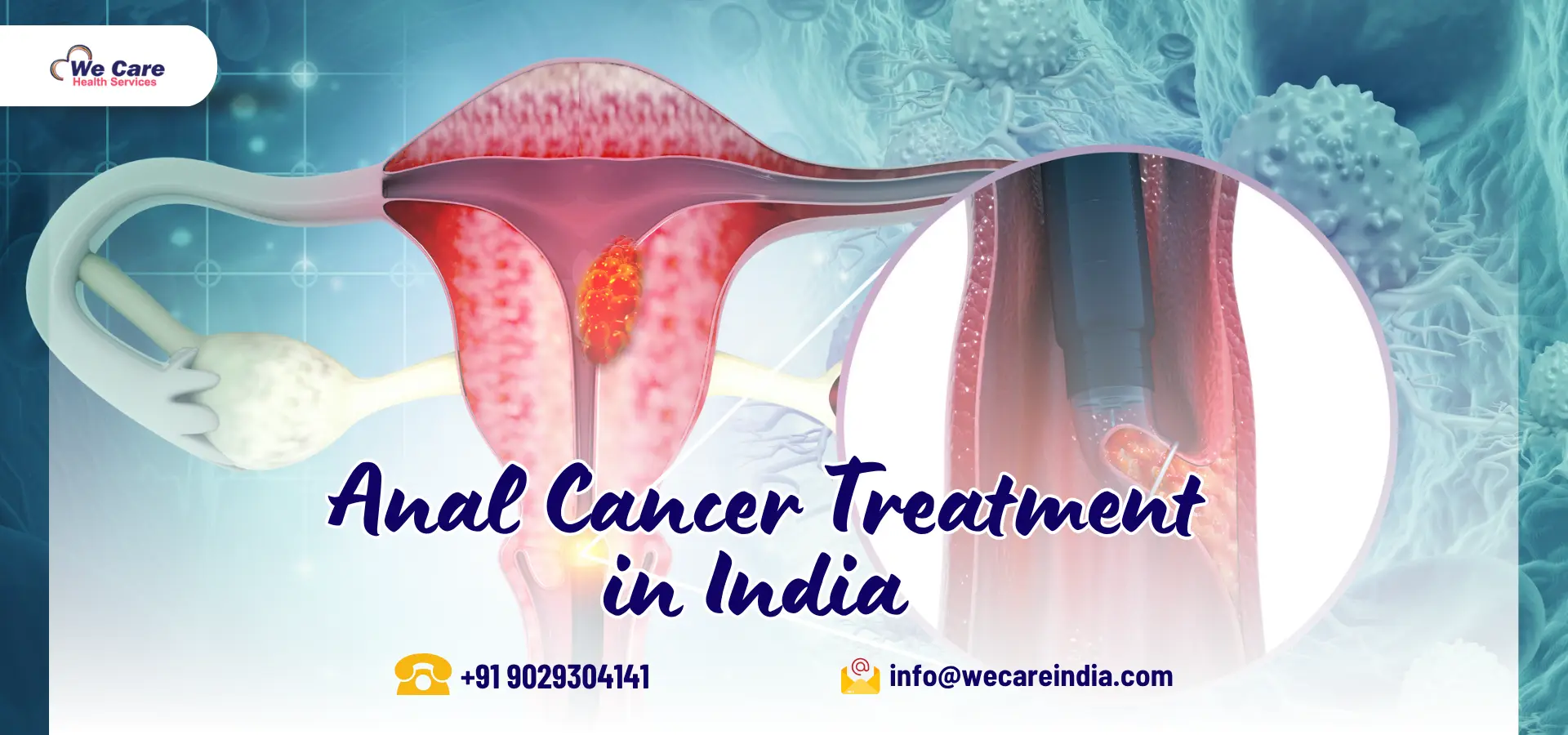 Anal Cancer Treatment in India