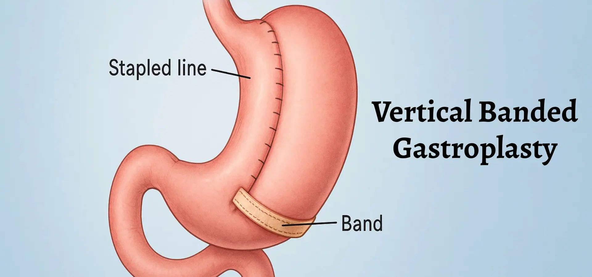 Vertical banded gastroplasty