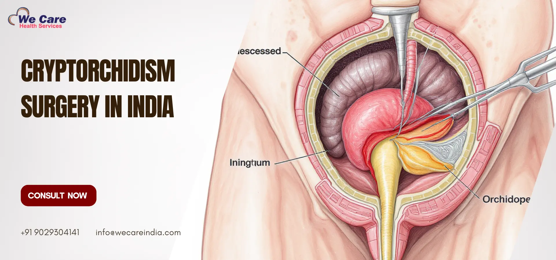 Cryptorchidism Surgery in India