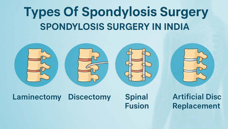 Types of Spondylosis Surgery