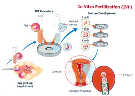 IVF, IVF treatment, cost of IVF treatment in India, IVF in India

