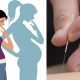 acupuncture and infertility